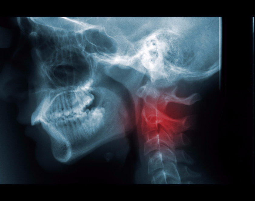 broken-neck.jpg.39b33de081520bb5cab6d1ecaa3ab52b.jpg