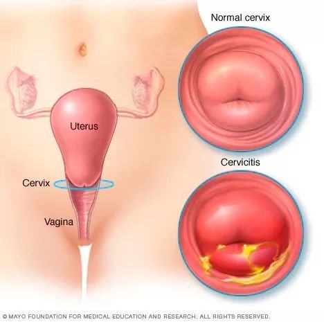 cervicitis.jpg
