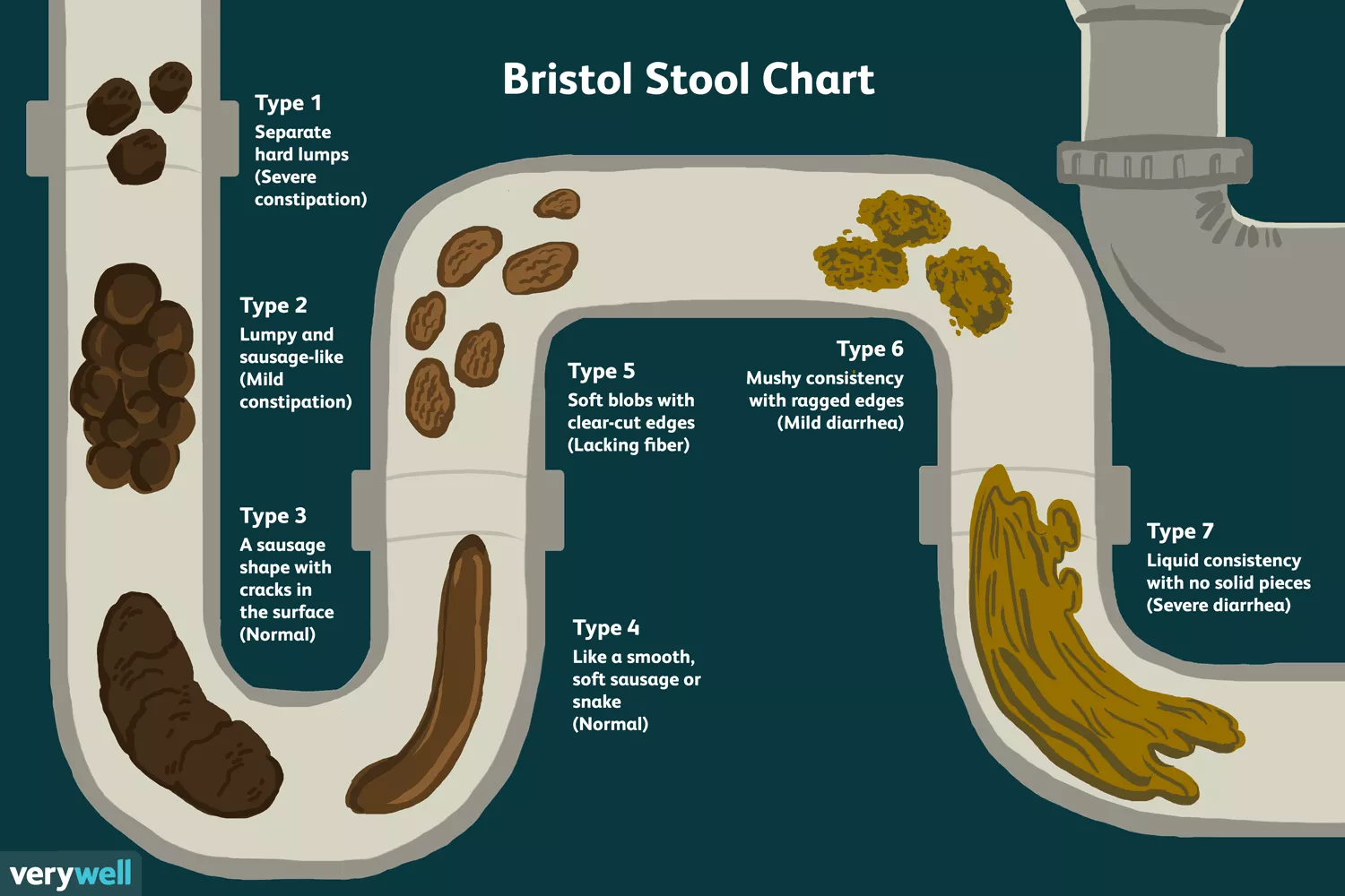 bristol-stool-chart-4174964-v3-5bda0c2cc9e77c0051ed7541.webp.e1eed15bc4845bc2dae3124d5e351bb1.webp