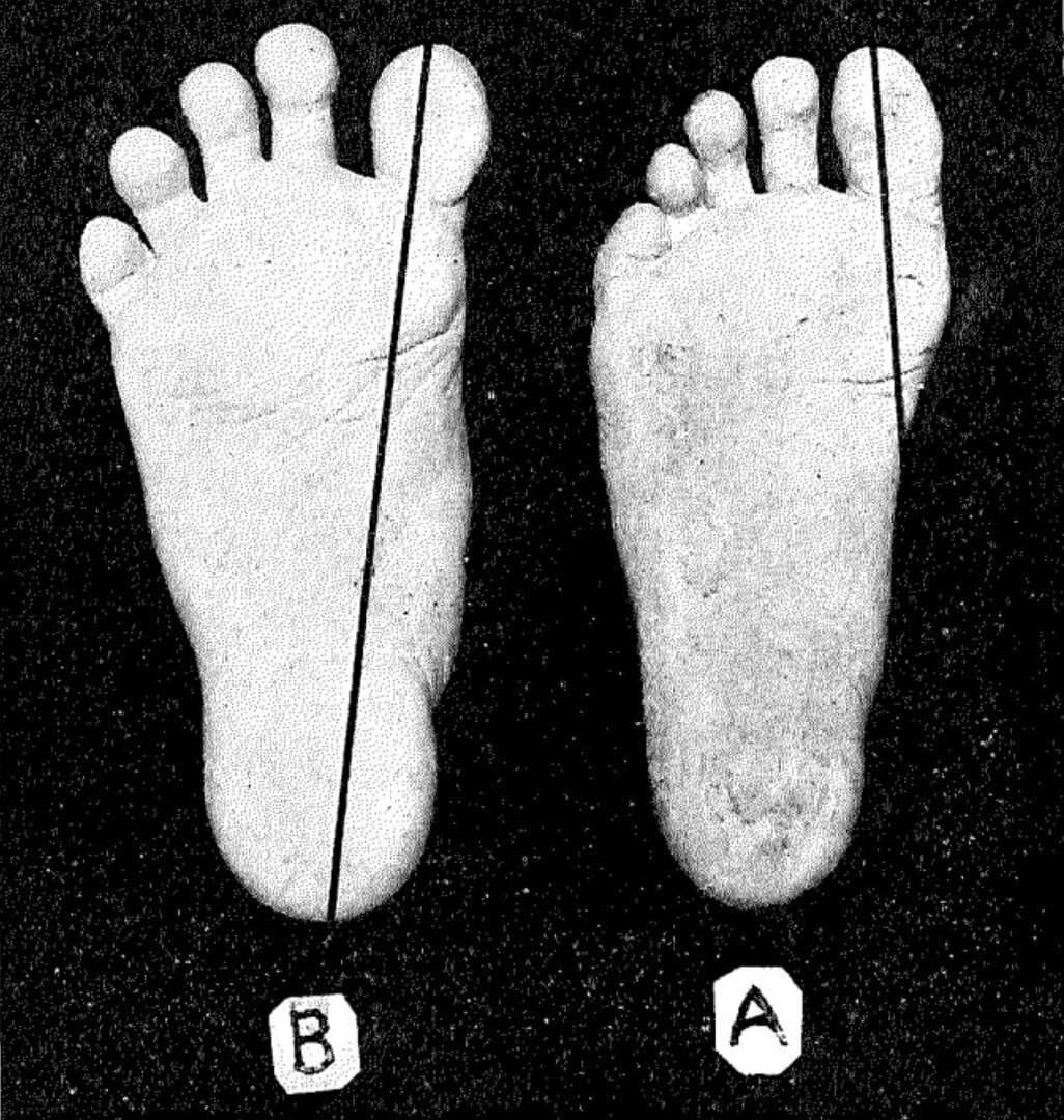 bunions (32).jpg